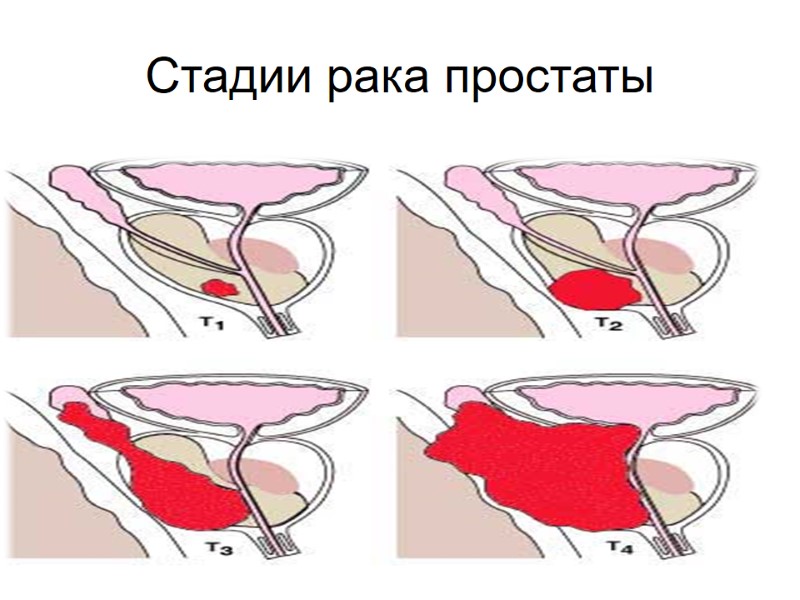 Стадии рака простаты